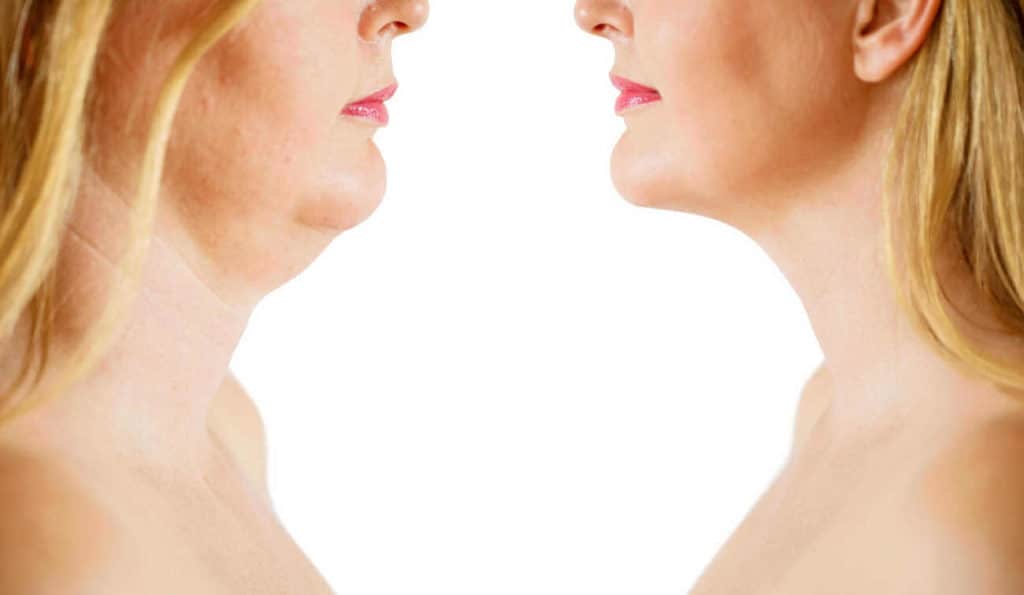 Double Chin treatment Derbyshire before and after results
