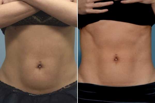 body sculpting FAQs Derbyshire