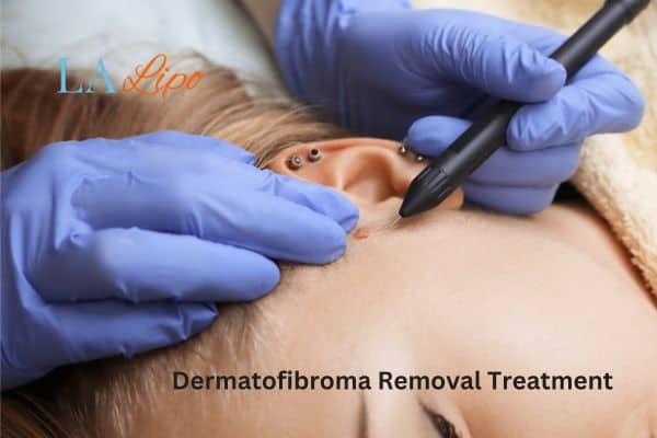 Dermatofibroma Removal Treatment Derbyshire