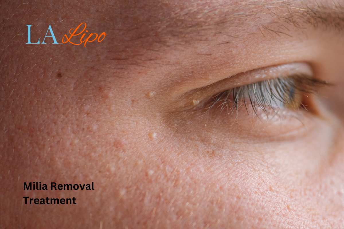 Cryopen Milia Removal: Is It the Easiest and Safest Option Derbyshire?