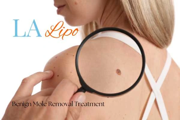 Why getting moles removed Derbyshire can boost your confidence!