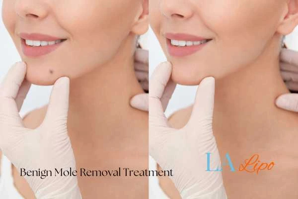 Woman's before and after results of being moles removal treatment Derbyshire
