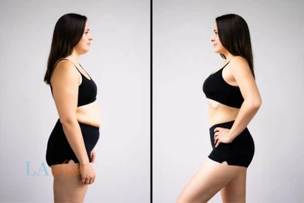 image of woman before and after results of LA-EMS Body Sculpting Derbyshire to help treat Diastasis recti