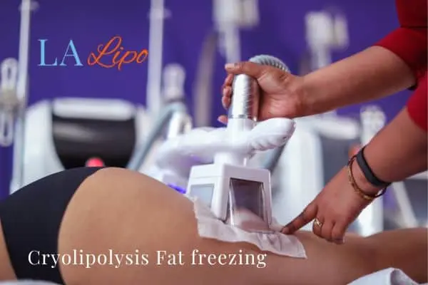 women getting fat freezing Derbyshire