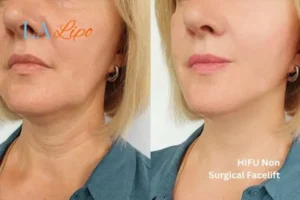 hi-fu for wrinkles Derbyshire before and after results