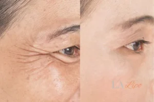 Before and after results of woman - HI-fu wrinkles reduction treatment Derbyshire
