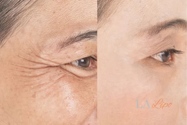 Before and after results of woman - HI-fu wrinkles reduction treatment Derbyshire