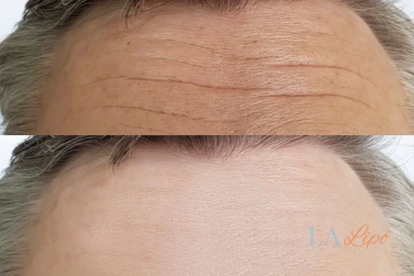 results of HIFU Derbyshire on mans forehead to help reduce lines and wrinkles