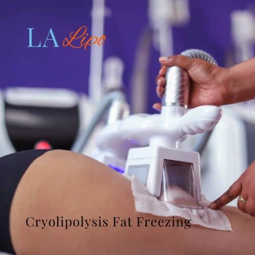 fat freezing - Cryolipolysis Derbyshire