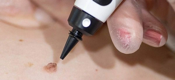 skin tag removal using cryopen Derbyshire