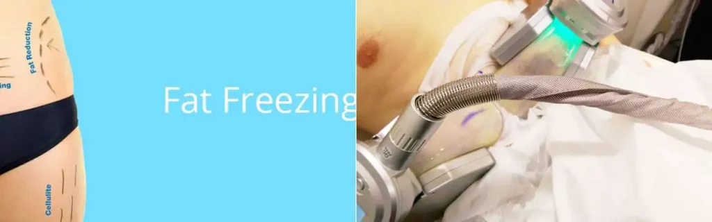 multi areas of a persons body having coolsculpting Derbyshire treatment