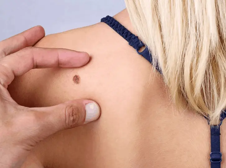woman having mole removal Derbyshire consultation before treatment.
