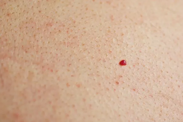 close up of a cherry angioma Derbyshire