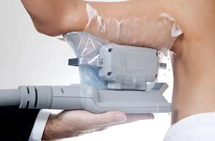 Picture of fat freezing Derbyshire on the upper arms.