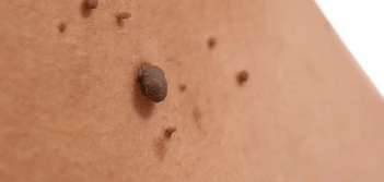 image of a skin tag Derbyshire