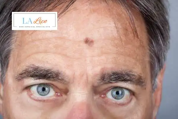 Solar Lentigo Removal Derbyshire image of man with mark on his forehead