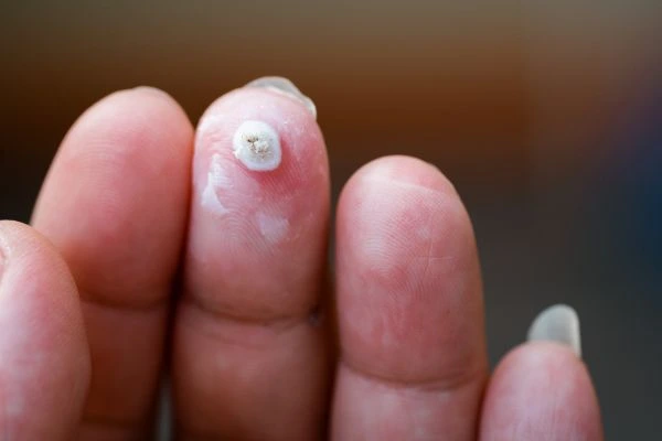 wart on person finger - cryotherapy to treat from LA LIPO Derbyshire