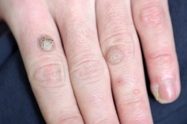photo of warts on person hand - see wart removal Derbyshire from LA LIPO