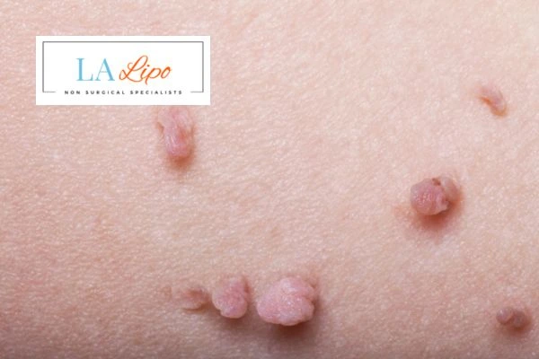 Does cryopen skin tag removal Derbyshire hurt? Find out now call our team today!