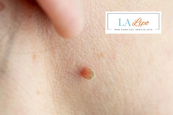 Book skin tag removal Derbyshire today speak to our team now!