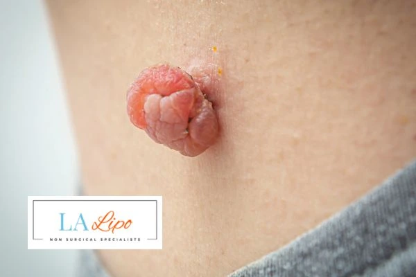 Interested in skin tag removal Derbyshire? Concerned about the pain? Find out more today!