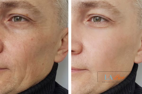See the amazing results of Morpheus8 Treatment Derbyshire!