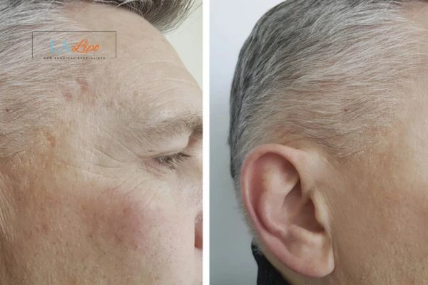 Mens Before & After Morpheus 8 Results Derbyshire
