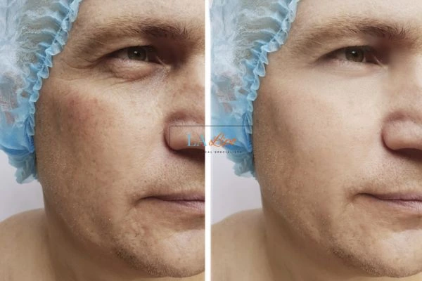 Before and after Morpheus 8 Results Derbyshire