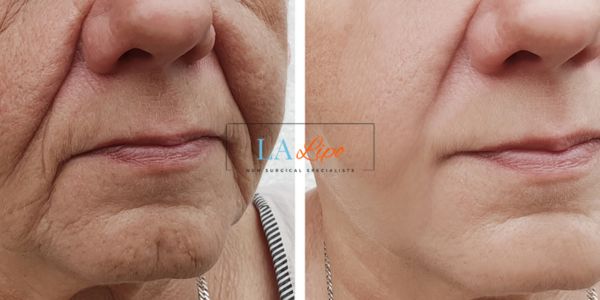Older lady deeper wrinkle reduction - LA LIPO Morpheus 8 Results Derbyshire
