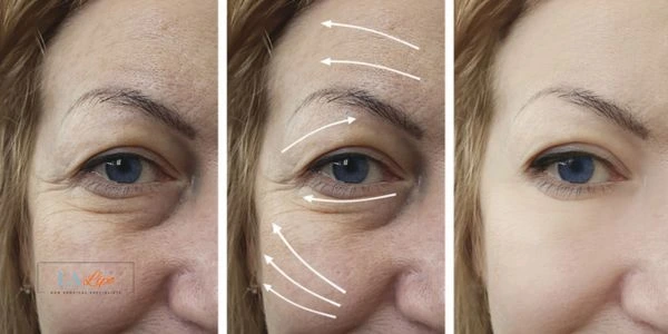 Amazing eye lift Morpheus 8 results Derbyshire