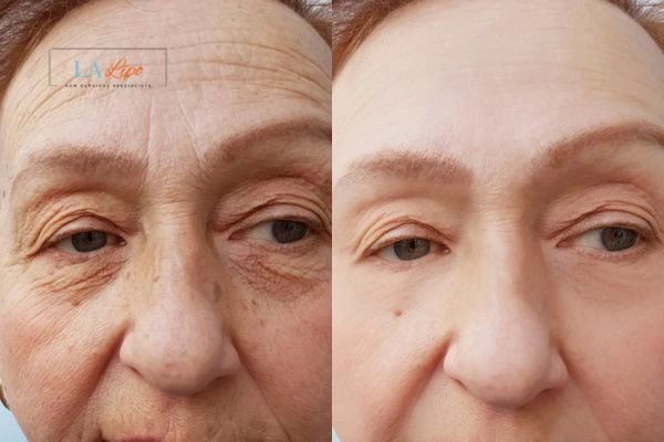 The powerful benefits of Morpheus8 Treatment Derbyshire - Call Our team today!