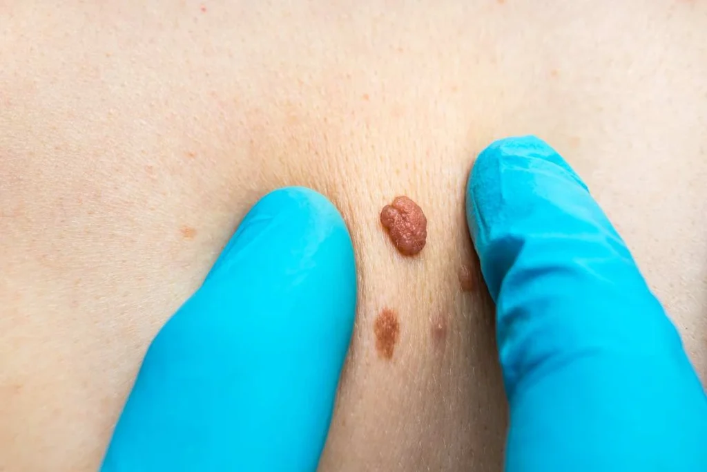 LA LIPO Cryopen Lesion Removal Prices Derbyshire