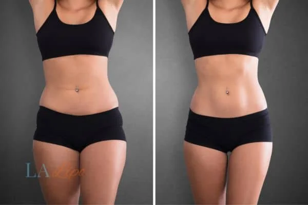before and after results of non-surgical treatment to help a woman's body image and mental health Derbyshire
