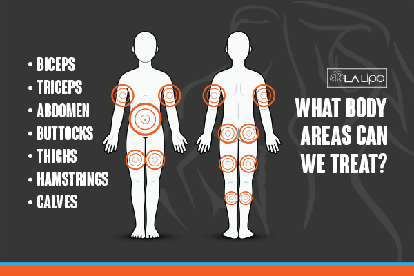 Diagram to show areas you can have LA-EMS Body Sculpting Treatment Derbyshire