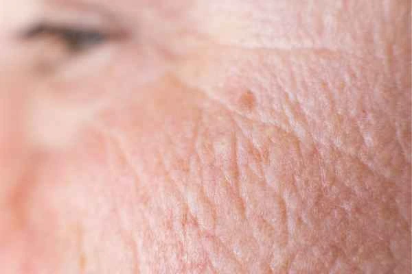 close up picture of a woman's face showing an age spot Derbyshire