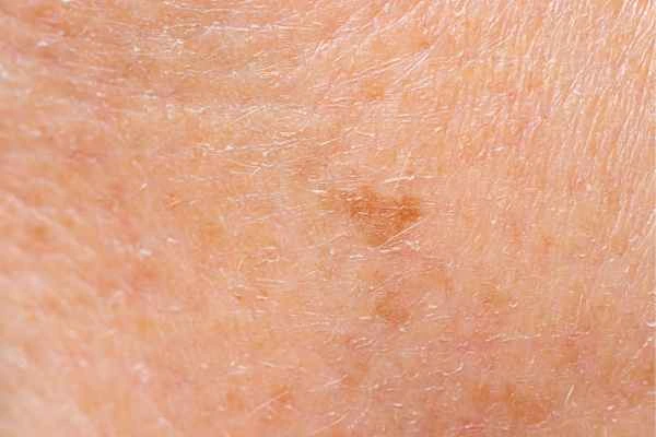 close up picture of age spots Derbyshire