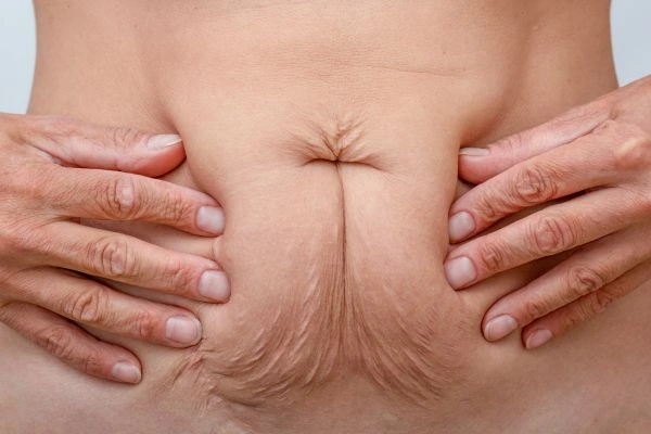Image of a woman's stomach with loose skin - example of skin tightening Derbyshire options