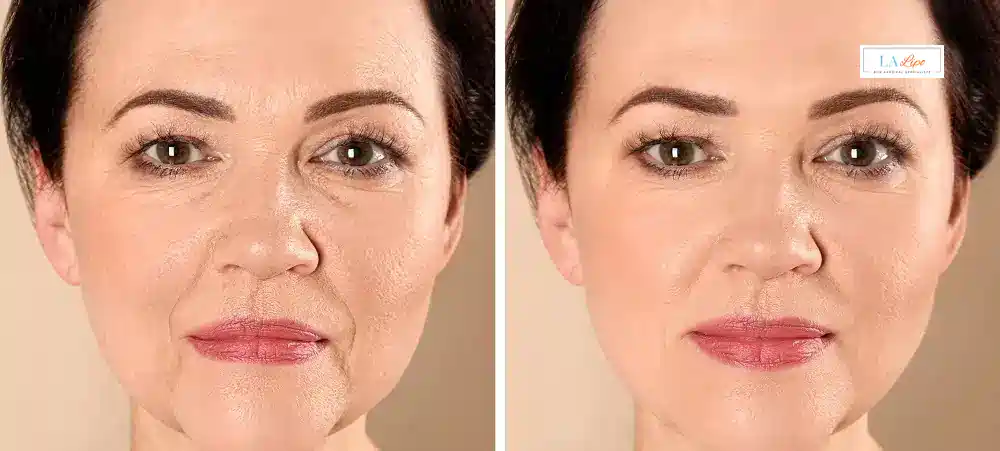 How Long Does It Take to See Results and How Long Do They Last Derbyshire?