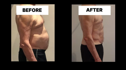 What Symptoms Can Diastasis Recti Cause in Men? Weak Core, Back Pain and Poor Posture Derbyshire